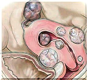 Uterine fibroids. 