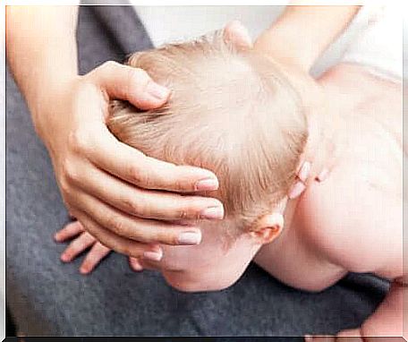 Craniosynostosis in a baby.