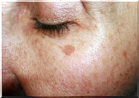 Spots on the skin.