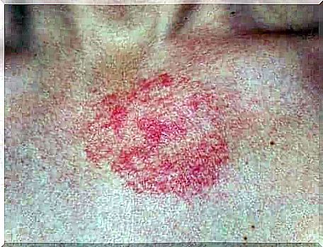 Dermatitis on the skin.