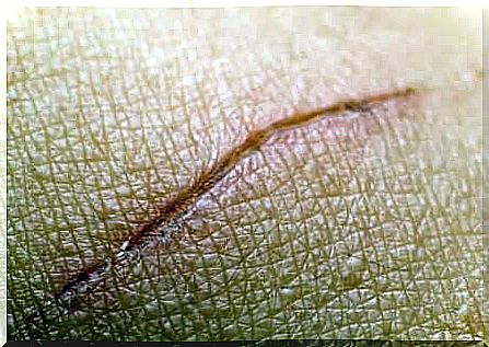 A skin scar. 