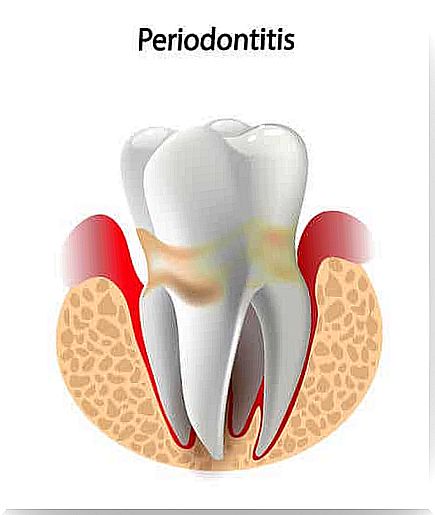 Periodontal disease.