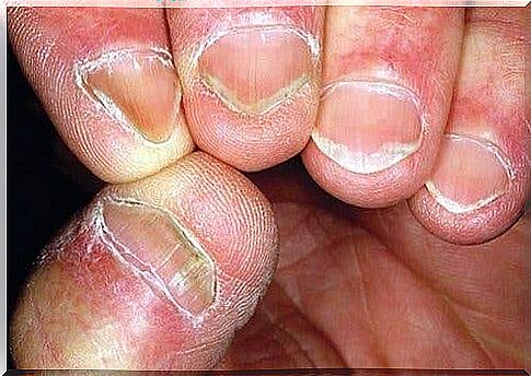 Hallopeau syndrome causes damage to the skin and nails